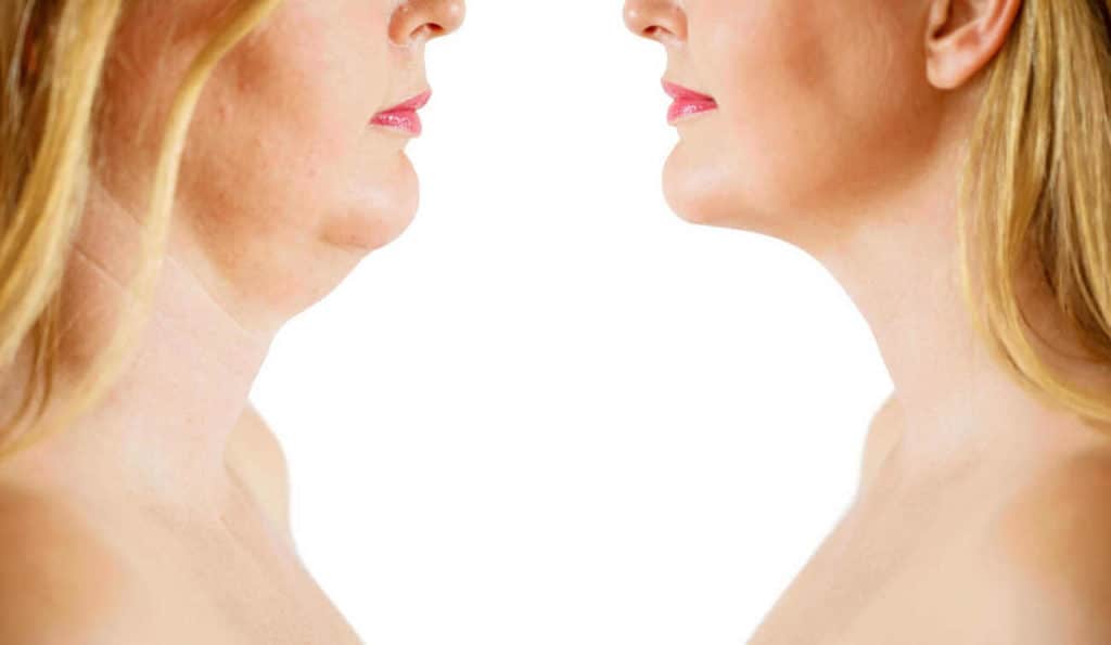 Double Chin treatment Dover before and after results