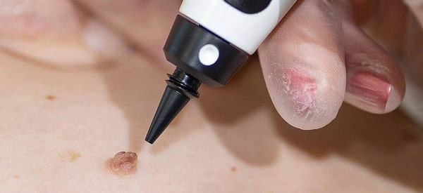 After Skin Tag Removal Dover