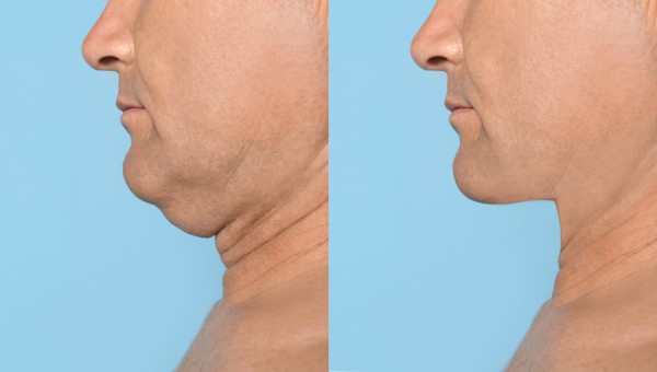 Which Non-Surgical Treatments Work Best for Jowls and Loose Skin Dover?