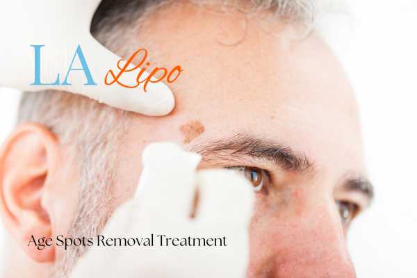What Are the Most Effective Treatments for Age Spots Dover?