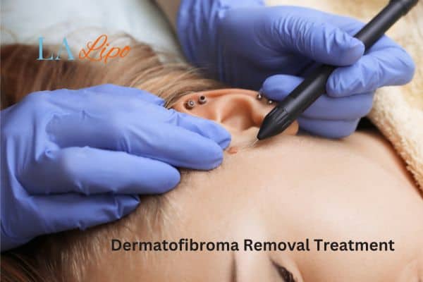 Dermatofibroma Removal Treatment Dover