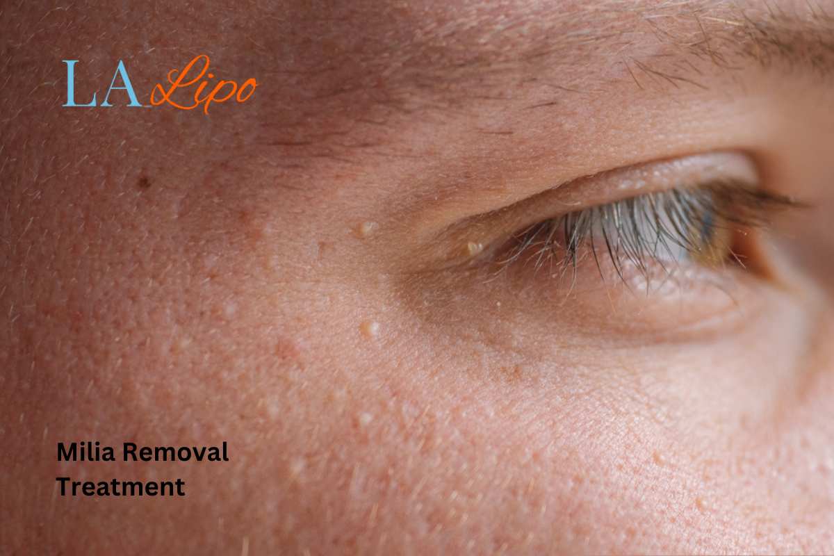 Cryopen Milia Removal: Is It the Easiest and Safest Option Dover?