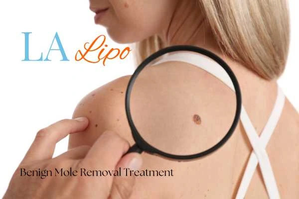 Why getting moles removed Dover can boost your confidence!