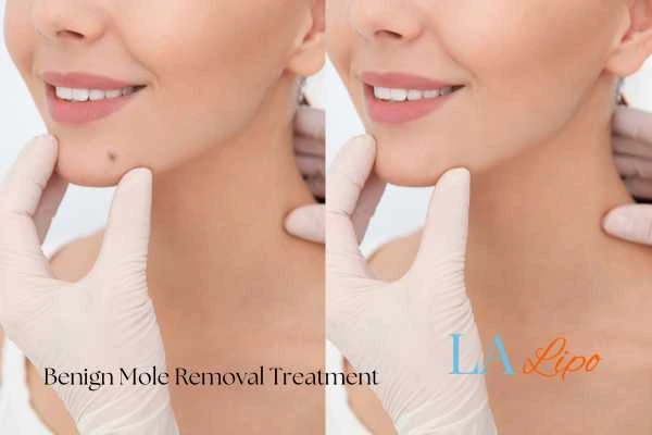 Woman's before and after results of being moles removal treatment Dover