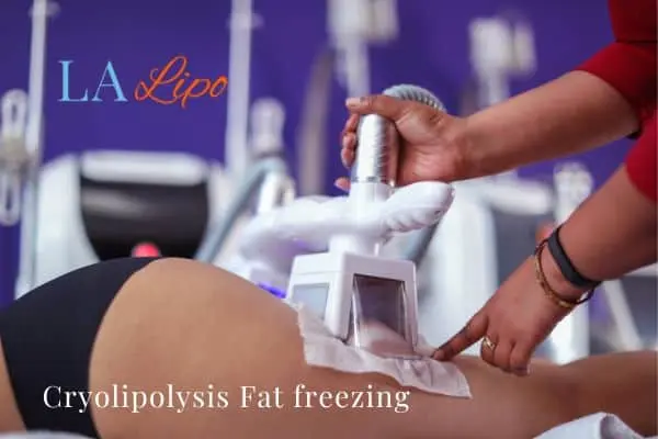 women getting fat freezing Dover