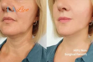 hi-fu for wrinkles Dover before and after results