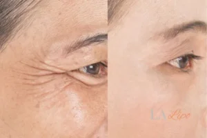 Before and after results of woman - HI-fu wrinkles reduction treatment Dover