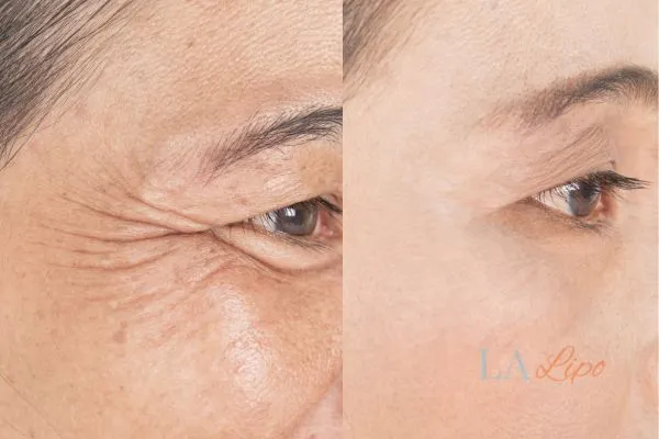 Before and after results of woman - HI-fu wrinkles reduction treatment Dover