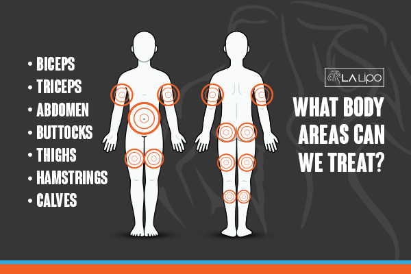 Graphic to show areas you can have LA-EMS Body Sculpting Dover treatment.