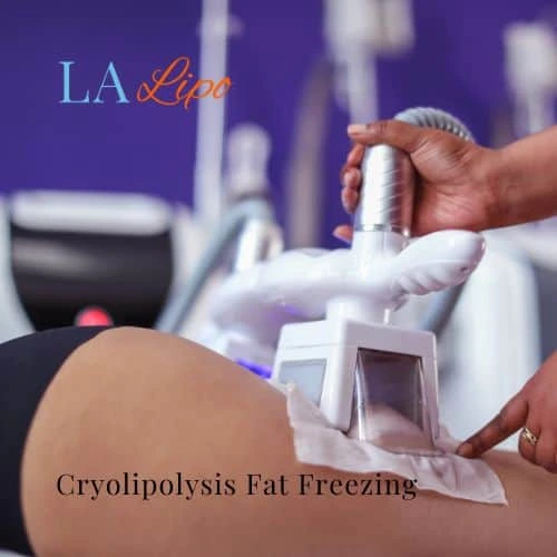 fat freezing - Cryolipolysis Dover