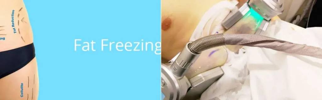 Fat freezing Dover on multiple areas of the body
