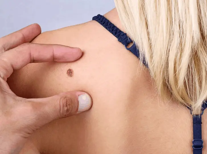 woman having mole removal Dover consultation before treatment.