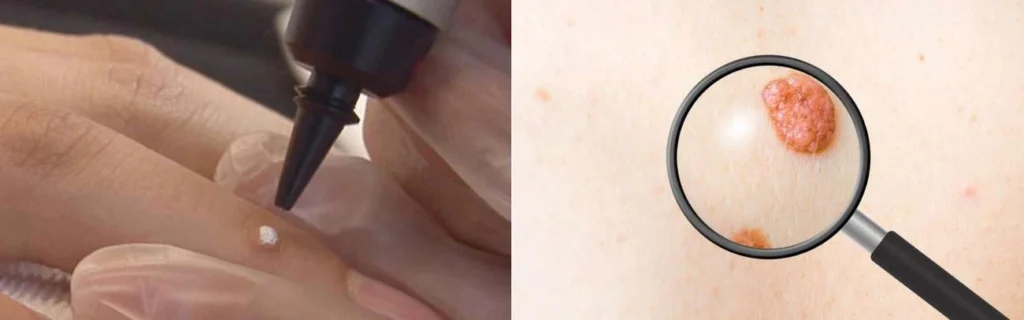 Person getting moles removed with cryopen Dover