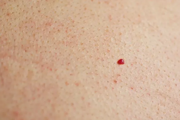 close up of a cherry angioma Dover