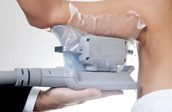Picture of fat freezing Dover on the upper arms.