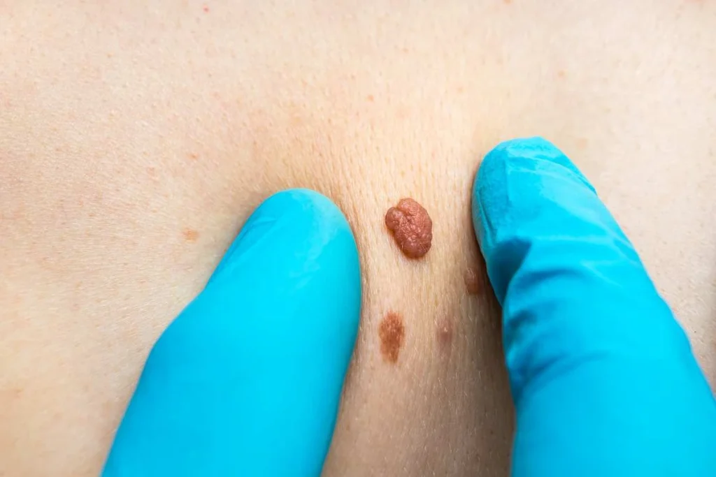 Consultant examining a skin tag Dover