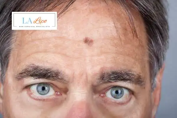 Solar Lentigo Removal Dover image of man with mark on his forehead