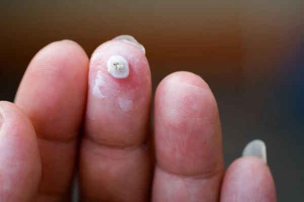 wart on person finger - cryotherapy to treat from LA LIPO Dover