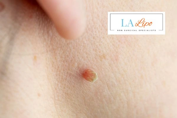 Book skin tag removal Dover today speak to our team now!