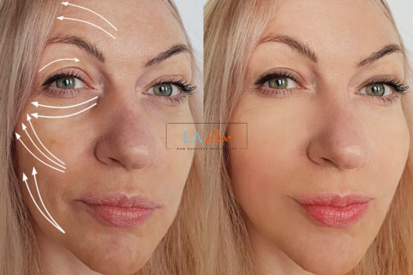 Morpheus 8 results Dover face lift.
