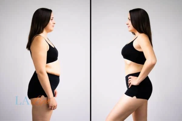 Picture of womans before and after using LA-EMS body sculpting to improve her core strength Dover