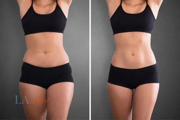 before and after results of non-surgical treatment to help a woman's body image and mental health Dover
