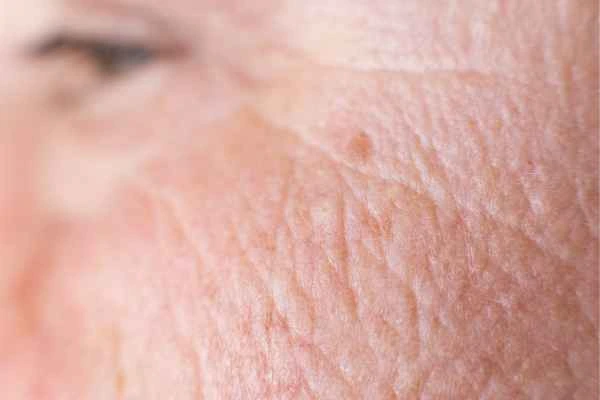 close up picture of a woman's face showing an age spot Dover