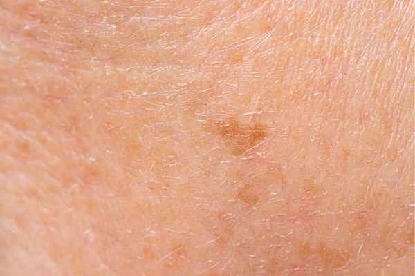 close up picture of age spots Dover