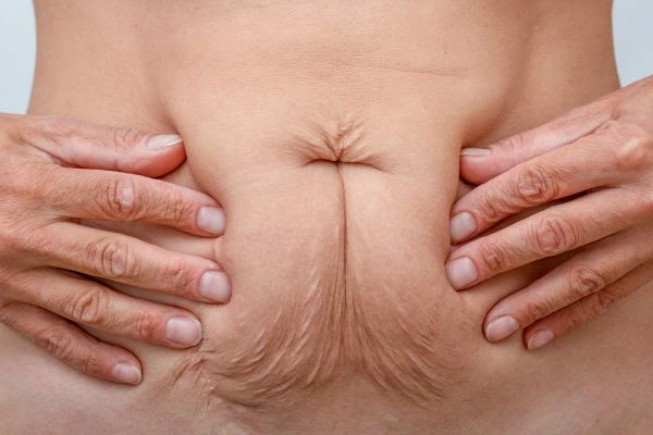 Image of a woman's stomach with loose skin - example of skin tightening Dover options