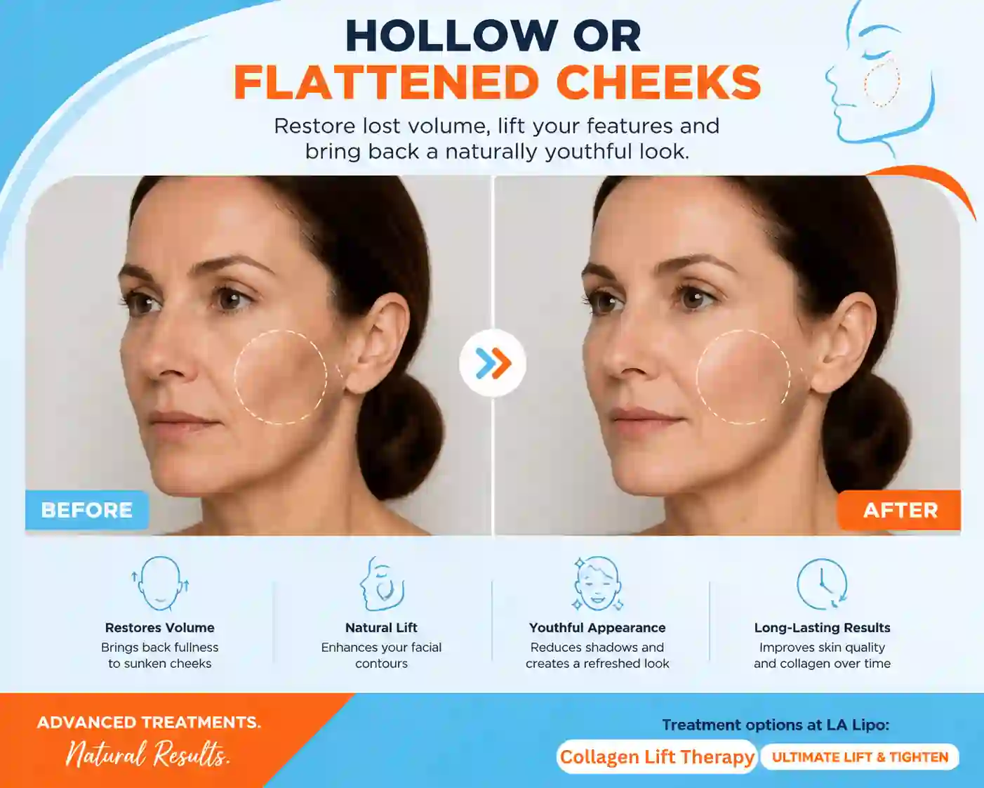 Sign #4: Hollow or Flattened Cheeks Dover